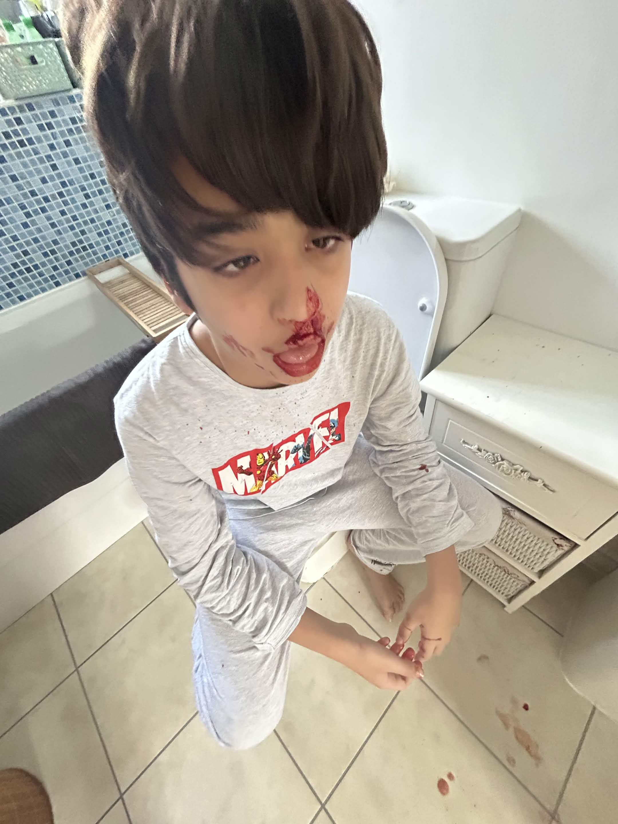Nose bleed 3.0